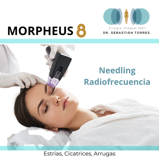 MORPHEUS 8 - Needling Radiofrecuencia - Estrias - Cicatrices