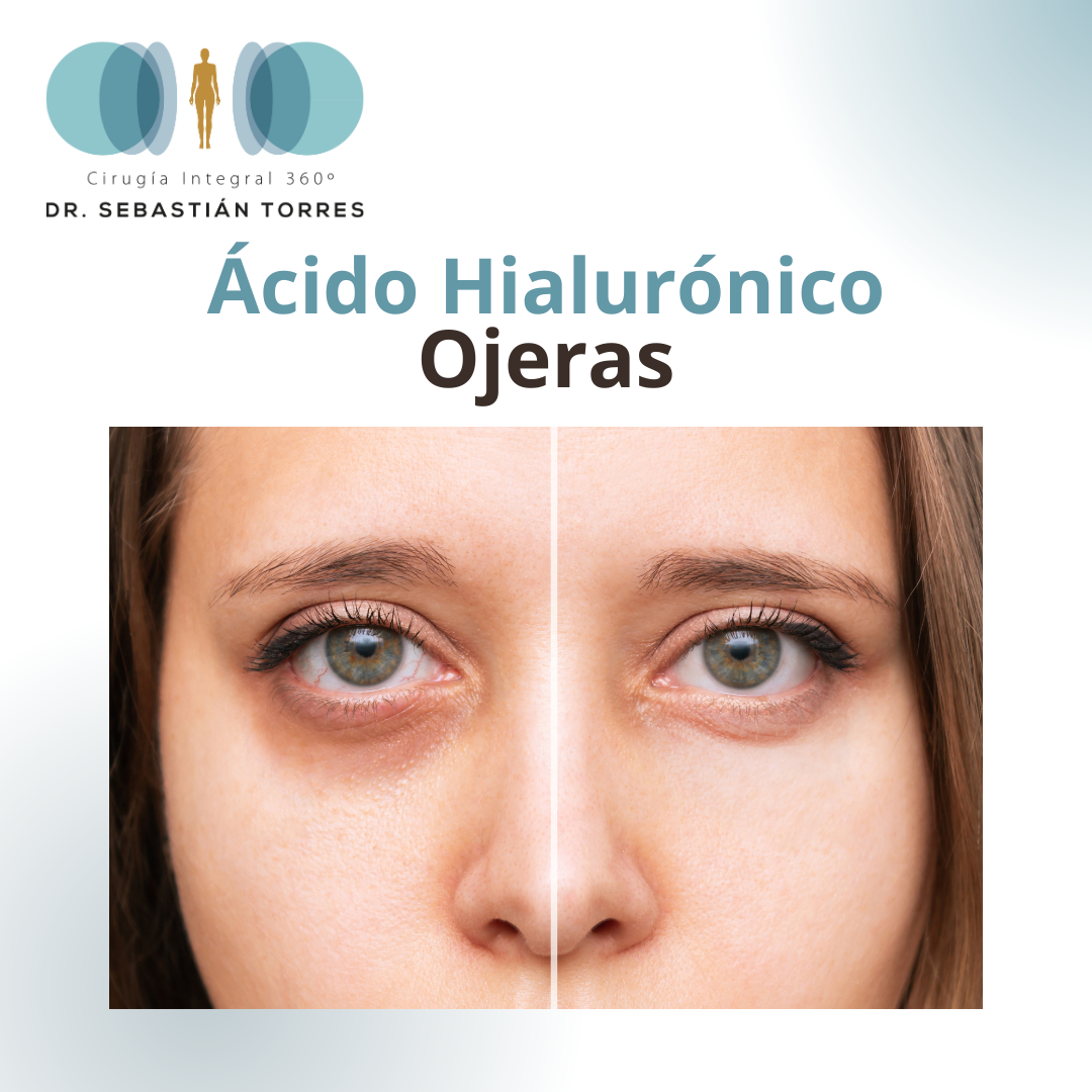 Ácido hialurónico ojeras